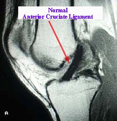 normal Nterior cruciate Ligament